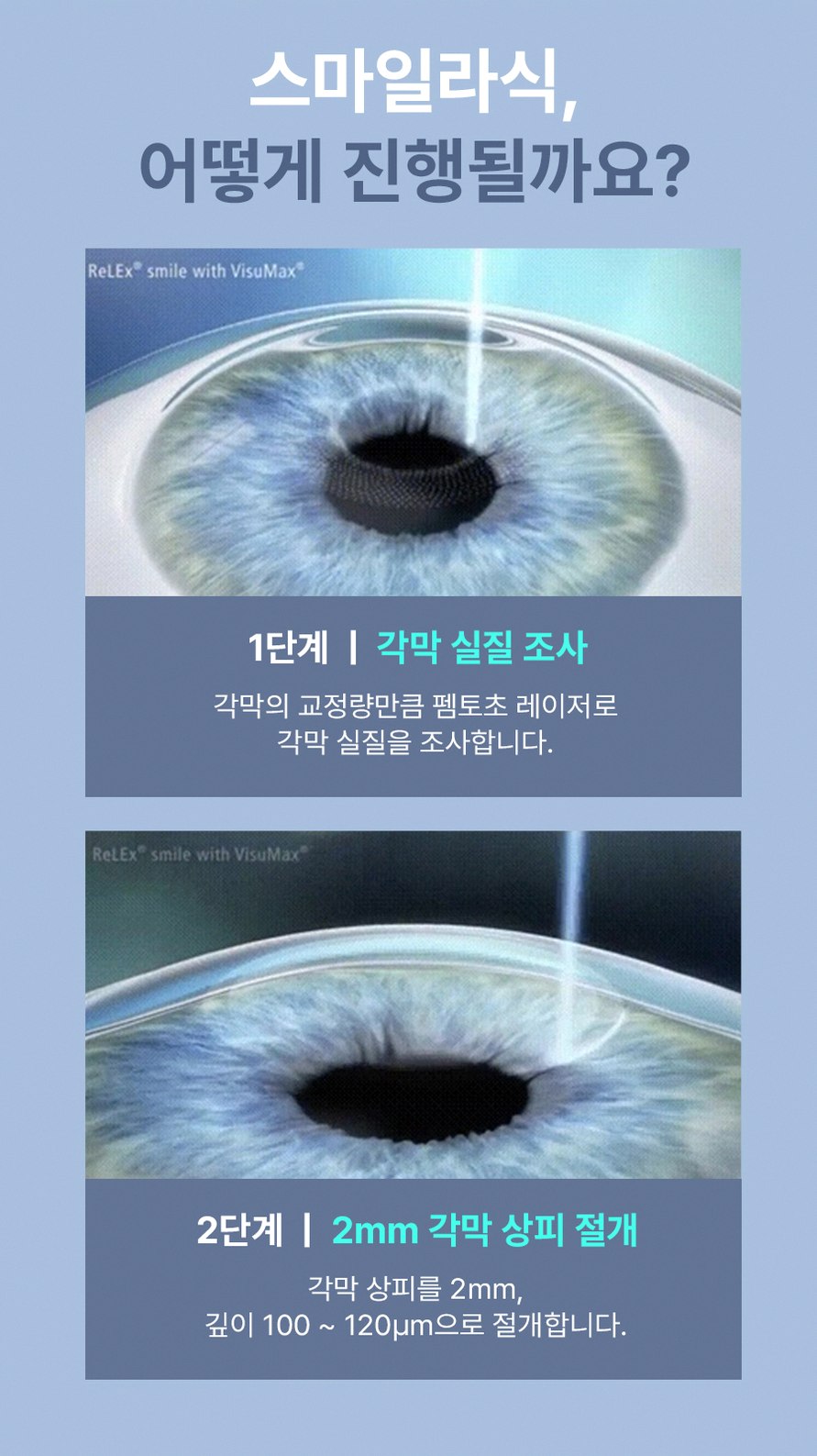 강남스마일라식 부작용 줄이기 3가지 핵심 포인트 7 1773912045 6 7b86e28d