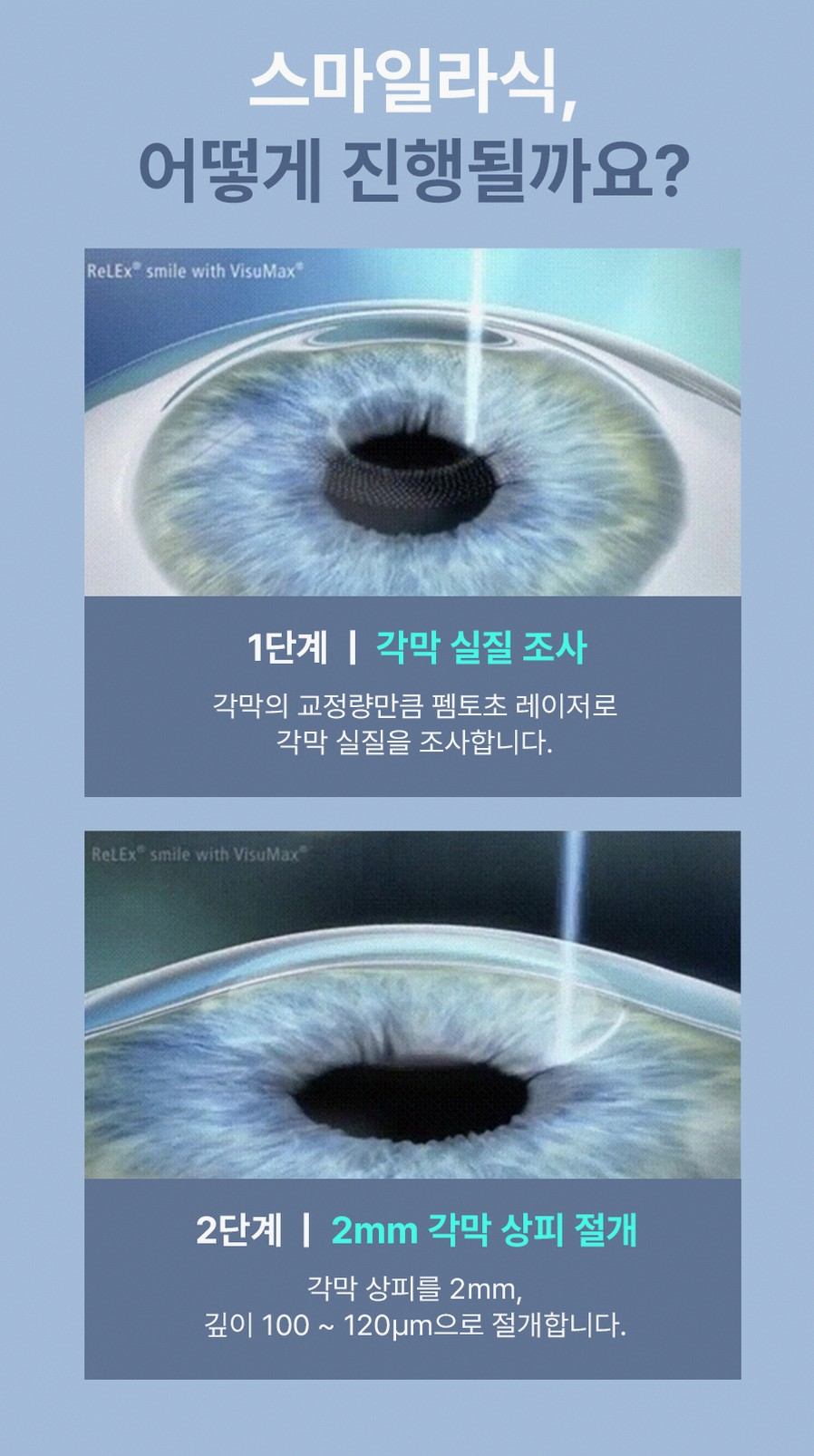 강남스마일라식효과 후회 줄이는 3가지 핵심 포인트 7 1773912045 6 ae2ef5a9