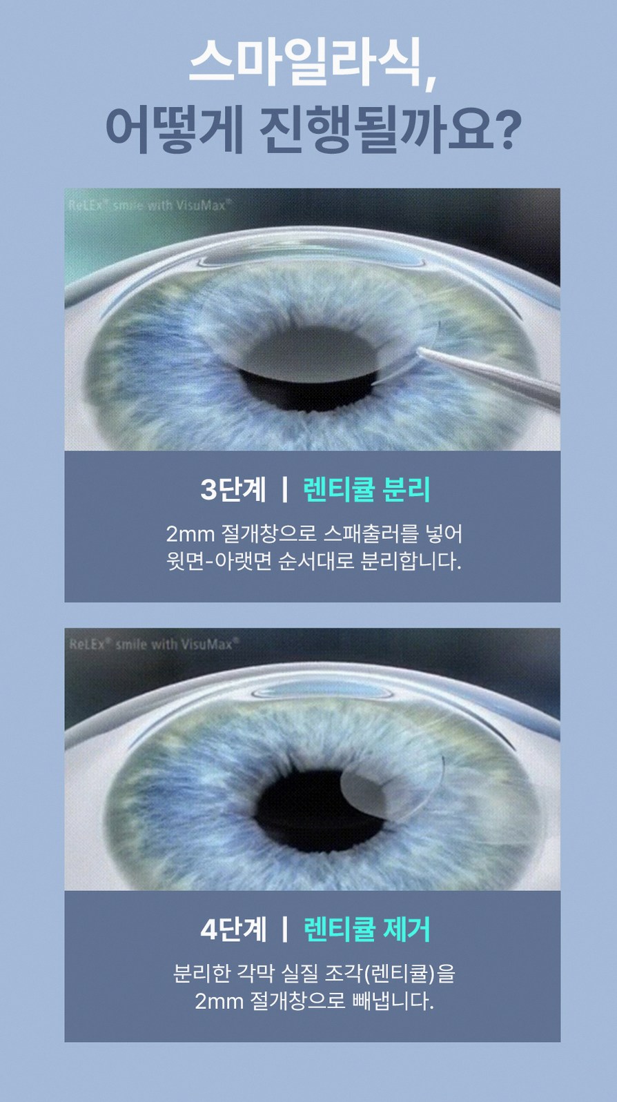 강남스마일라식효과 후회 줄이는 3가지 핵심 포인트 8 1773912045 7 82d5331a