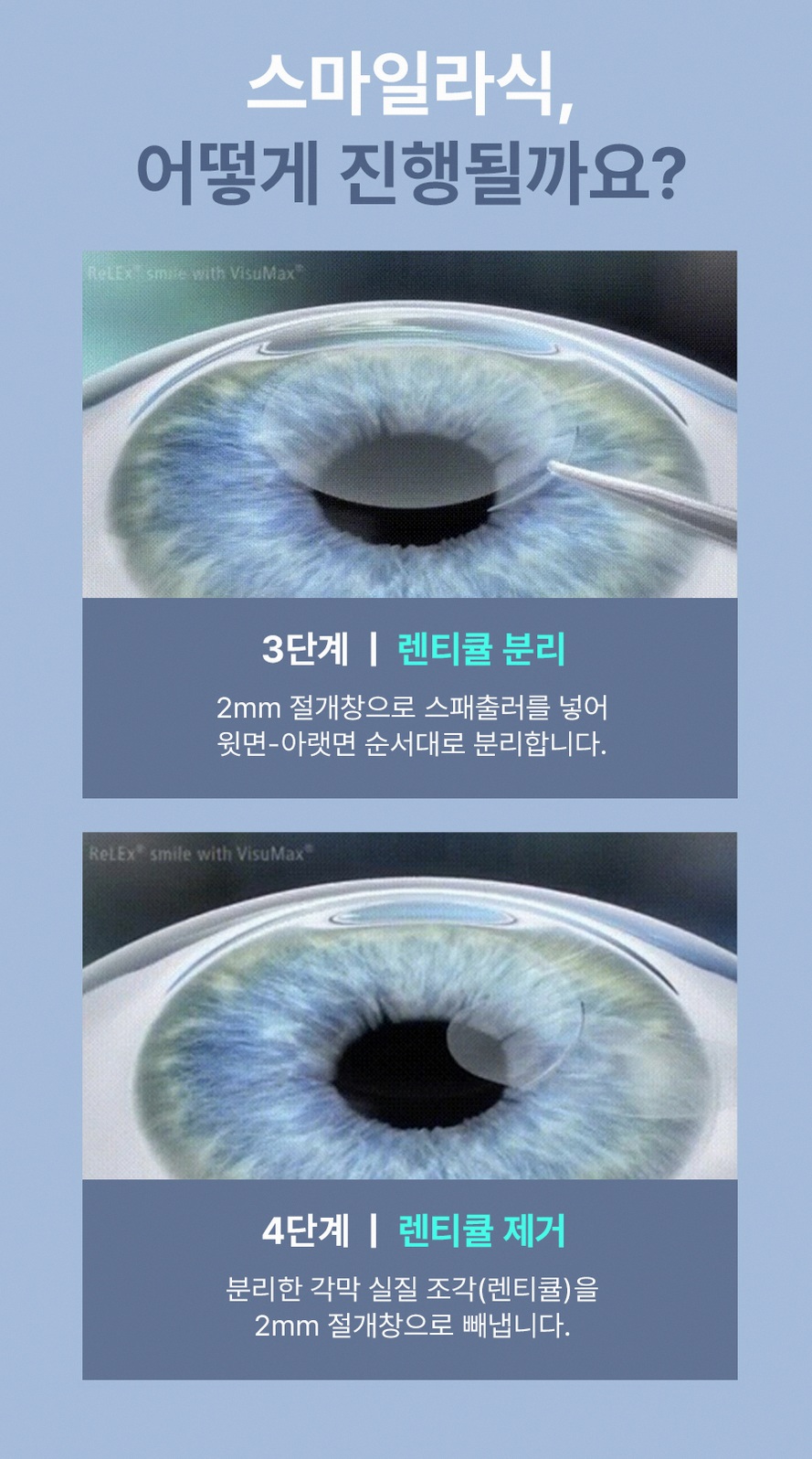 강남스마일라식 후회 없는 선택을 위한 5가지 핵심 정보 8 1773912045 7 f2ccc195