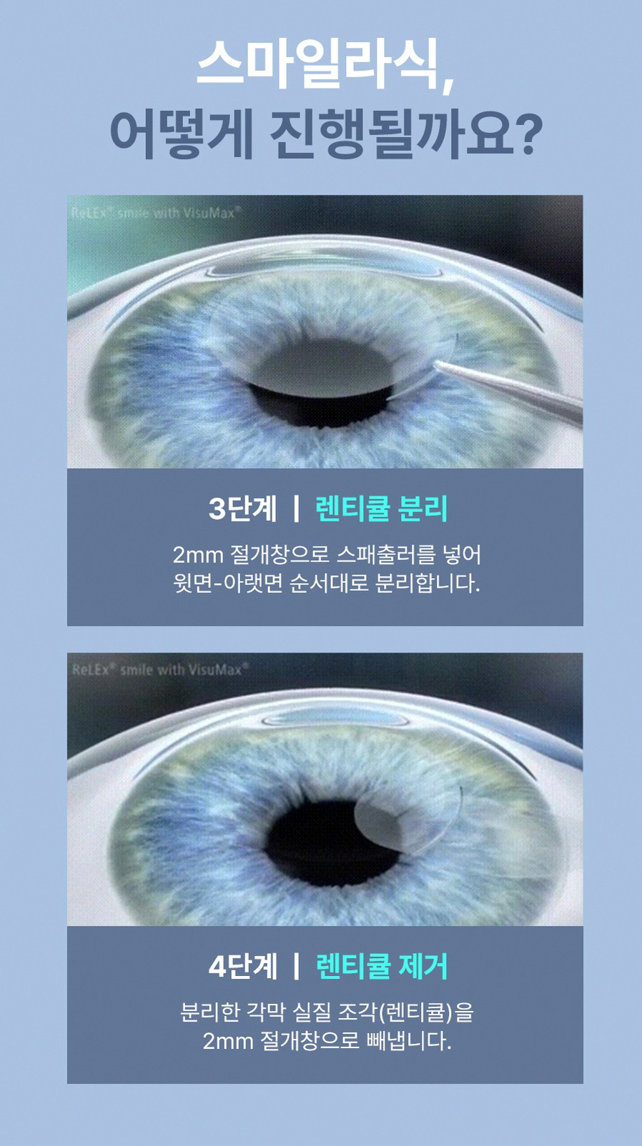 40대라식 후회 줄이는 3가지 선택 기준 8 1773912045 7 fa648ba1