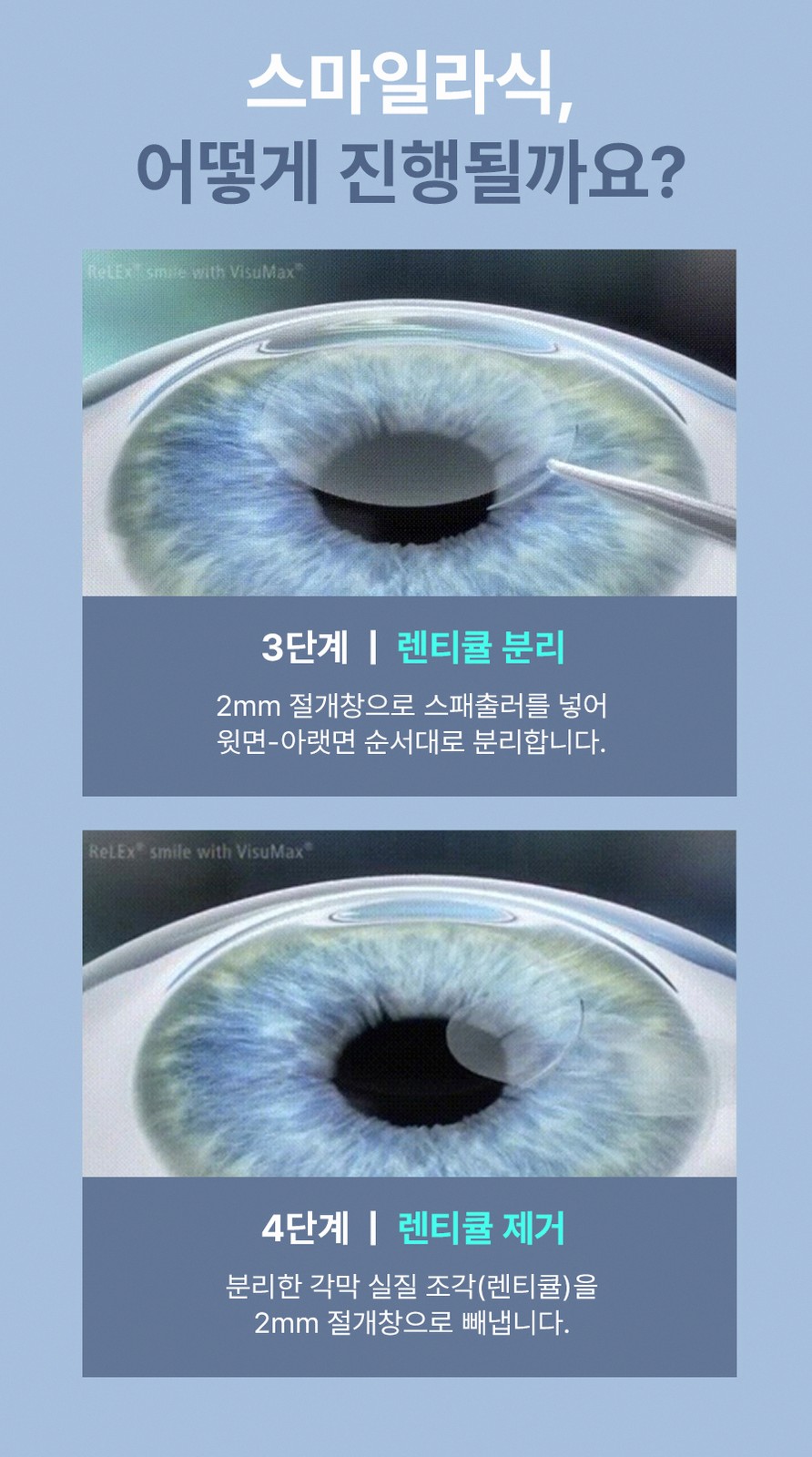 강남스마일라식 부작용 줄이기 3가지 핵심 포인트 8 1773912045 7 fc017750