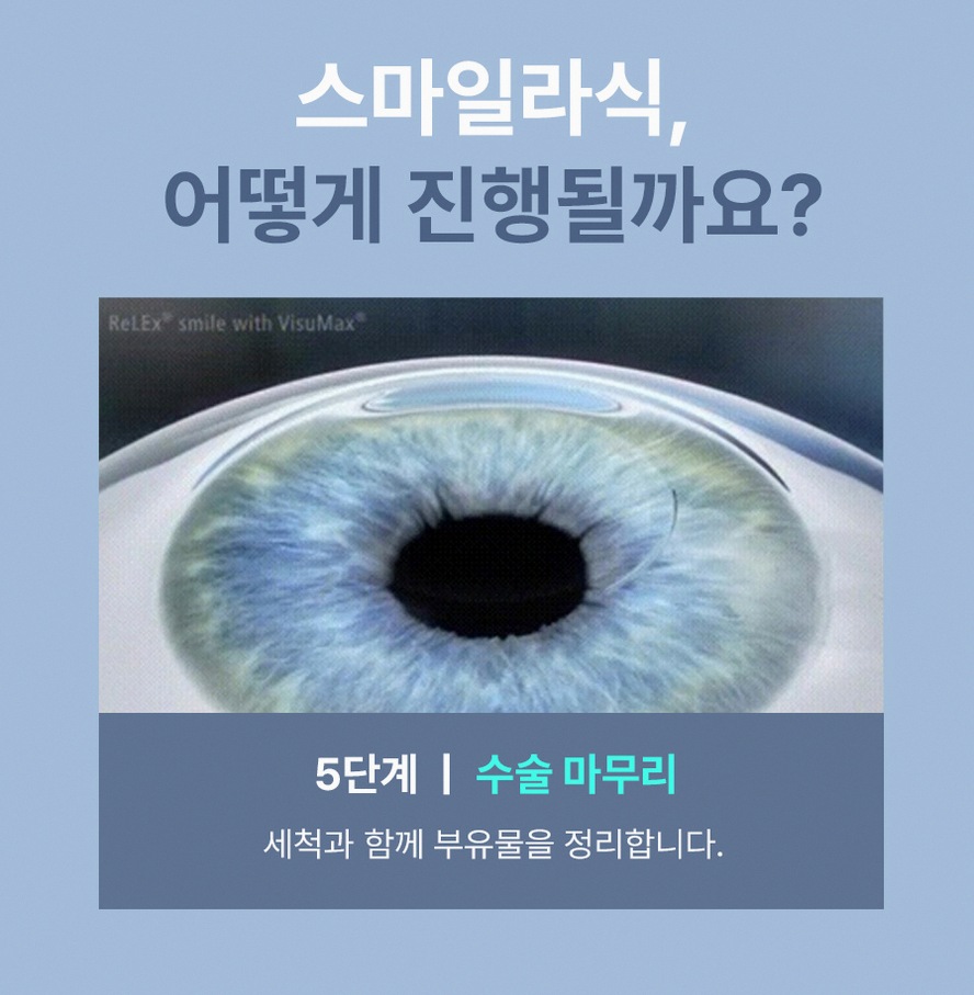 강남스마일라식 후회 없는 선택을 위한 5가지 핵심 정보 9 1773912045 8 0487f8fa
