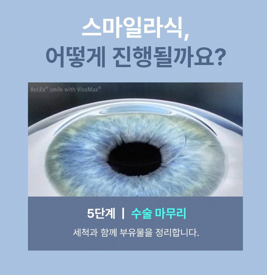 강남스마일라식효과 후회 줄이는 5가지 핵심 정보 9 1773912045 8 6618f38c