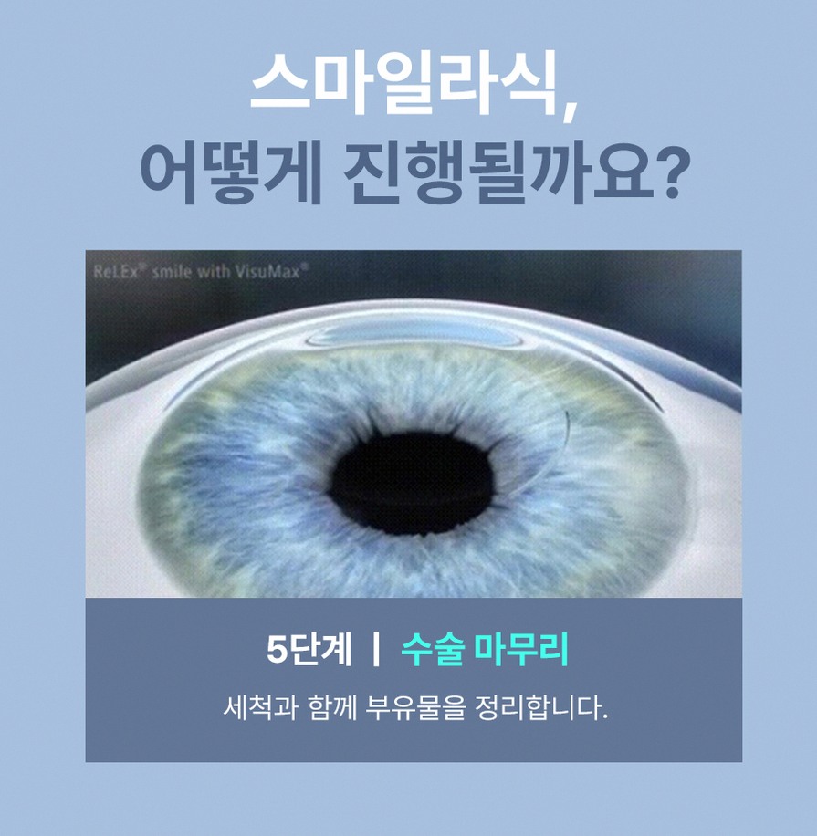 40대라식 후회 줄이는 3가지 선택 기준 9 1773912045 8 b997316a
