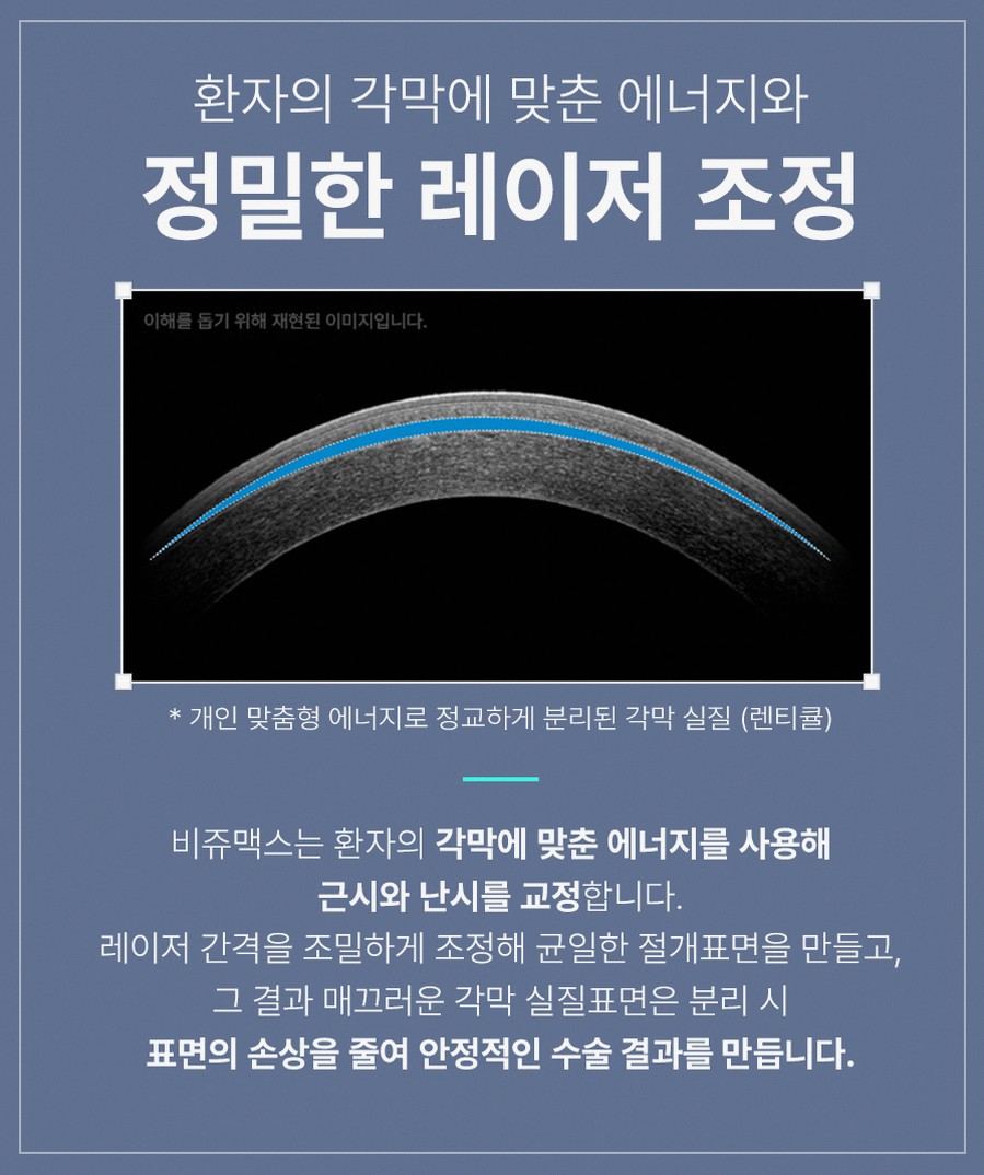 강남스마일라식 후회 없는 선택을 위한 5가지 핵심 정보 10 1773912045 9 7199cb06