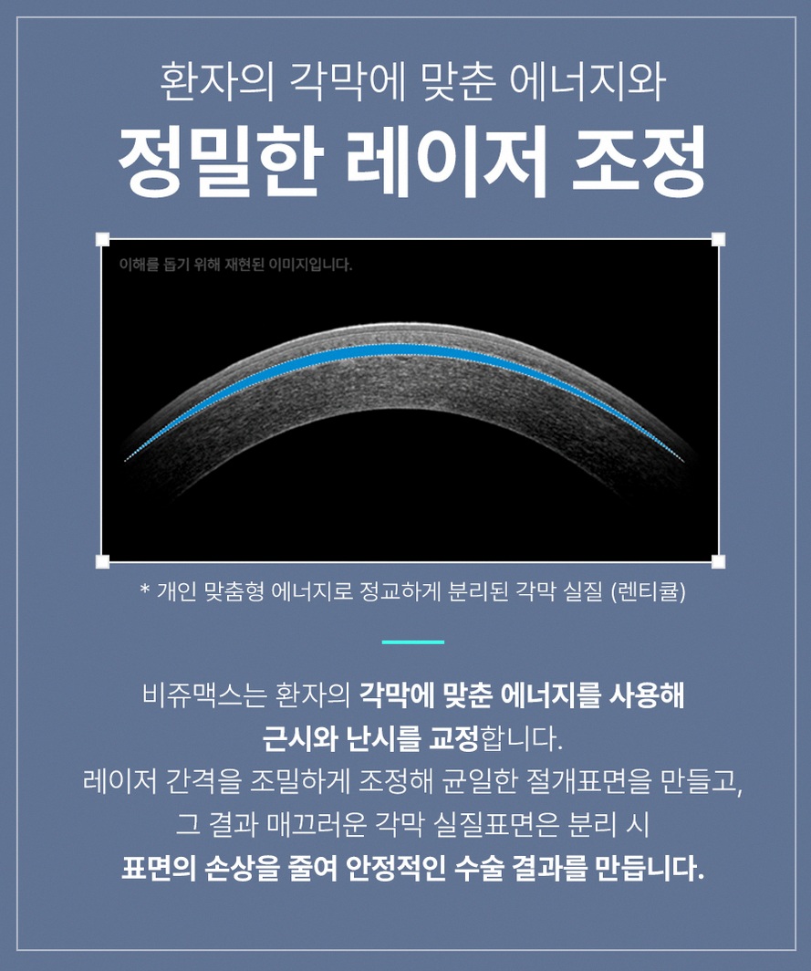 강남스마일라식추천 부작용 줄이기 전후 비교 핵심 기준 10 1773912045 9 a91620ef