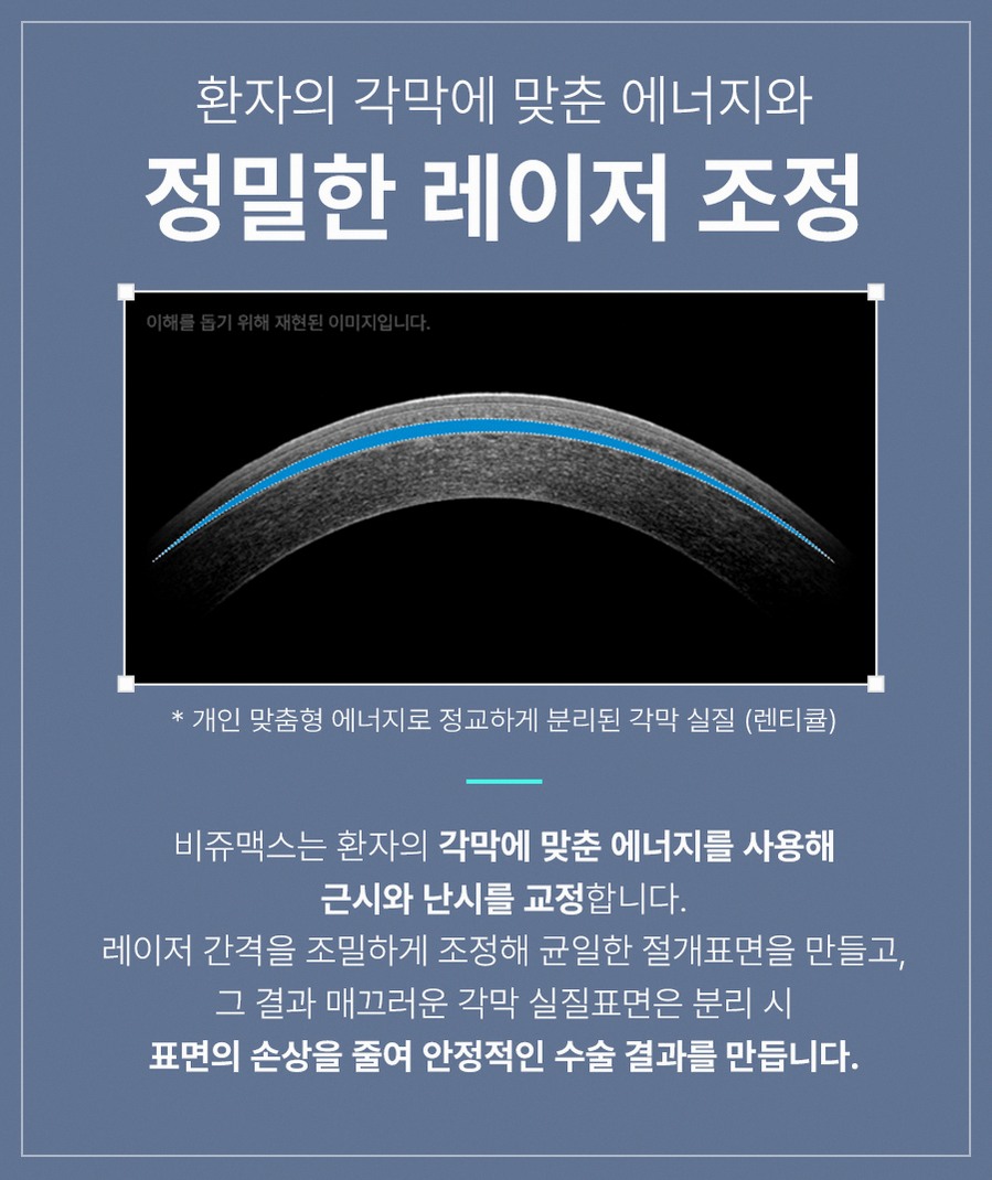 강남스마일라식비용 합리적 범위와 숨은 추가비용 포인트 10 1773912045 9 ee35e73b