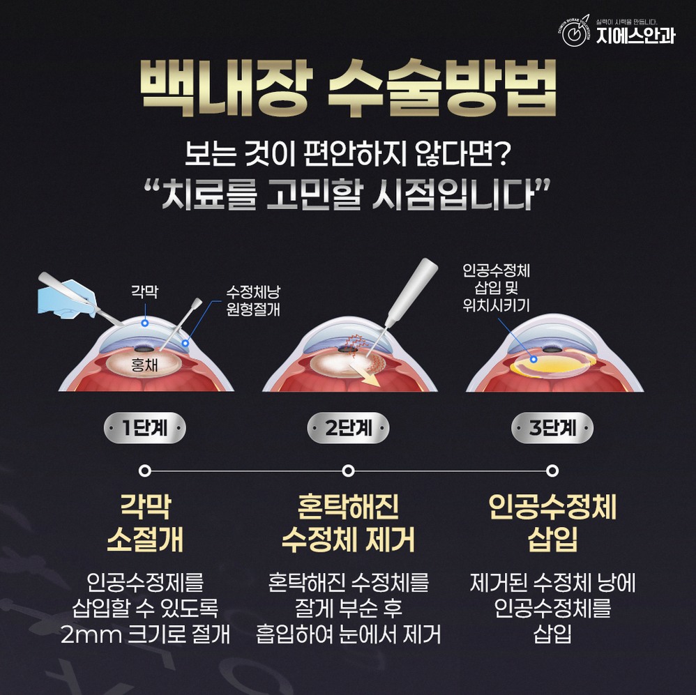 백내장수술정보 안내, 수술 전후 과정과 회복 과정 정리 8 본문 내용을 보조하는 이미지