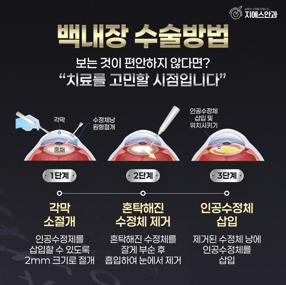 다초점인공수정체 선택 전 꼭 알아둘 점은 무엇인가요? 8 본문 내용을 보조하는 이미지